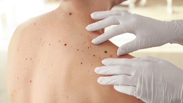 Someone wearing surgical gloves checking moles on woman's back